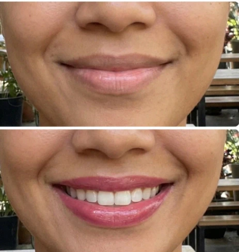 Vorher-Nachher Kisselle Lippenstift